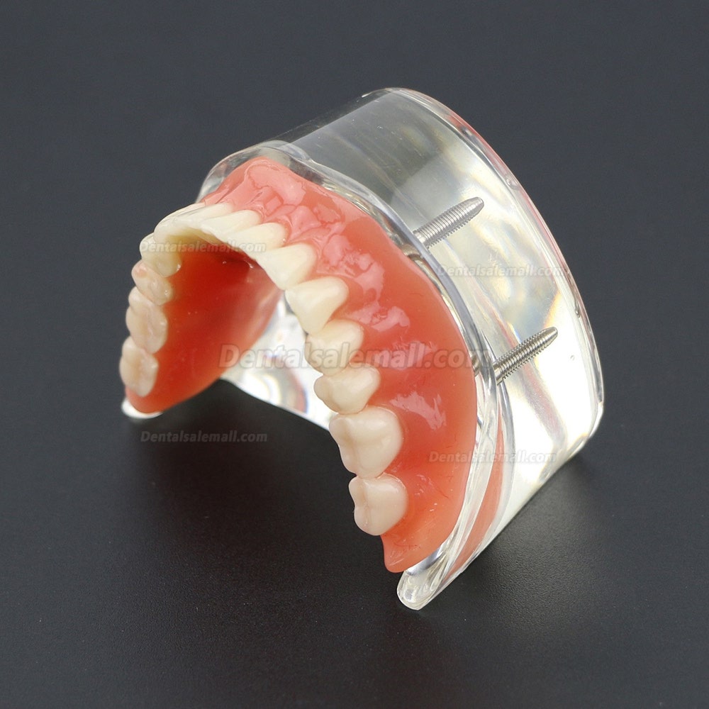 Dental Lower Teeth Demo Study Model 6002 02 Overdenture Inferior 4 Implants